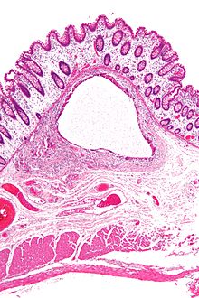 Micrograph showing large bowel wall with pneumatosis cystoides intestinalis, a generally benign subset of pneumatosis intestinalis. H&E stain.