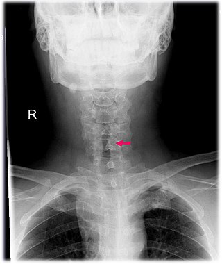 <span class="mw-page-title-main">Subglottic stenosis</span> Medical condition