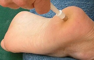 <span class="mw-page-title-main">Skin biopsy</span> Removal of skin cells for medical examination