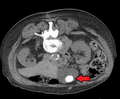 Batu ampadu gadang nan tampak jo CT-Scan