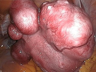 <span class="mw-page-title-main">Uterine fibroid</span> Medical condition with benign tumors of uterus