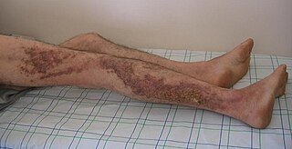 Dariers disease Human disease