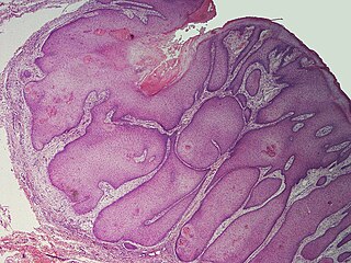 <span class="mw-page-title-main">Pilar sheath acanthoma</span> Medical condition