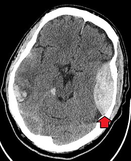 <span class="mw-page-title-main">Epidural hematoma</span> Build-up of blood between the dura mater and skull