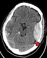 Haematoma epidurale cum aspectu biconvexo.