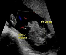 Gastrochisis in ultrasound: defect is right to midline. Gastrochisis 0001.jpg