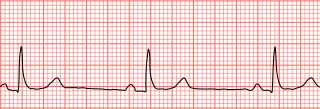 <span class="mw-page-title-main">Bradycardia</span> Heart rate below the normal range