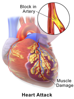 <span class="mw-page-title-main">Myocardial infarction</span> Interruption of blood supply to a part of the heart