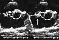 March 13: Endocarditis ultrasound