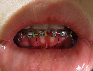 <span class="mw-page-title-main">Herpetic gingivostomatitis</span> Medical condition