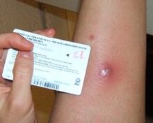 Although usually carried without symptoms, MRSA often presents as small red pustular skin infections Mrsa2.jpg