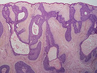 Basaloid follicular hamartoma benign tumor