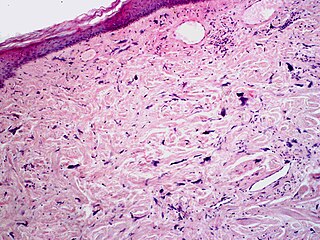 Pleomorphic fibroma