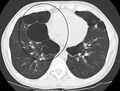 TAC axial do pulmão de uma pessoa em estado terminal de enfisema bolhoso.