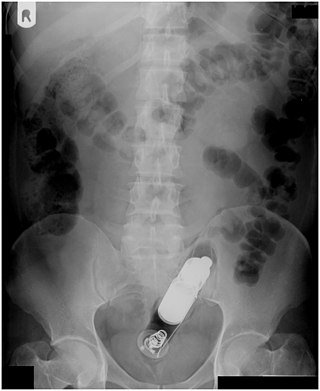 <span class="mw-page-title-main">Rectal foreign body</span> Large bodies found in the rectum in medical context