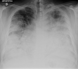 <span class="mw-page-title-main">Legionnaires' disease</span> Form of atypical pneumonia