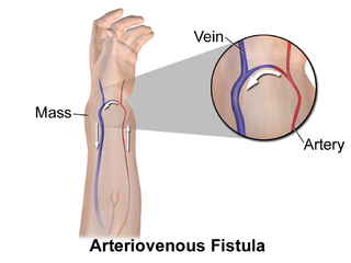 <span class="mw-page-title-main">Arteriovenous fistula</span> Medical condition