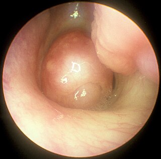 <span class="mw-page-title-main">Functional endoscopic sinus surgery</span> Surgery to enlarge the paranasal sinus drainage pathways