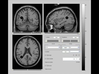 <span class="mw-page-title-main">Anaplastic oligodendroglioma</span> Human brain tumor