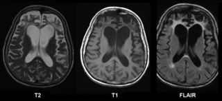 <span class="mw-page-title-main">Frontotemporal dementia</span> Types of dementia involving the frontal or temporal lobes