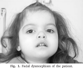 <span class="mw-page-title-main">Jacobsen syndrome</span> Medical condition