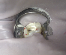 Root canal pulp removed, cleaned and made ready for filling and placing a crown Root Canal Edited.png