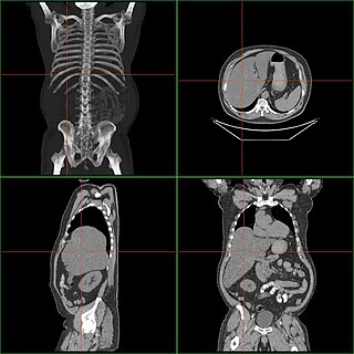 <span class="mw-page-title-main">Hepatomegaly</span> Medical condition