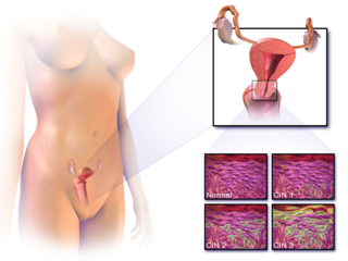 <span class="mw-page-title-main">Cervical cancer</span> Cancer arising from the cervix