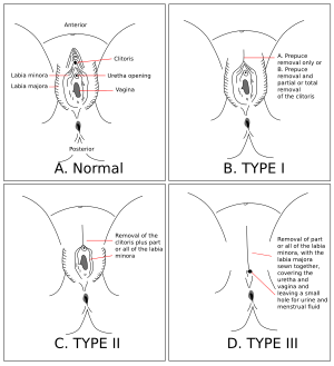 Diagram showing types of female genital mutilation