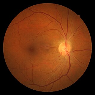 <span class="mw-page-title-main">Hypertensive retinopathy</span> Damage to the eyes retina due to high blood pressure