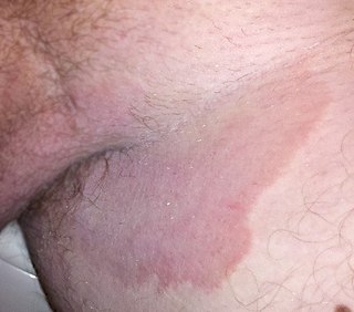 <span class="mw-page-title-main">Tinea cruris</span> Fungal infection