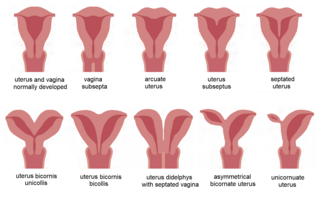 <span class="mw-page-title-main">Uterine malformation</span> Medical condition