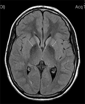 <span class="mw-page-title-main">Aceruloplasminemia</span> Medical condition