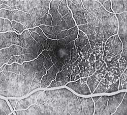 <span class="mw-page-title-main">Macular telangiectasia</span> Disease of the retina affecting central vision