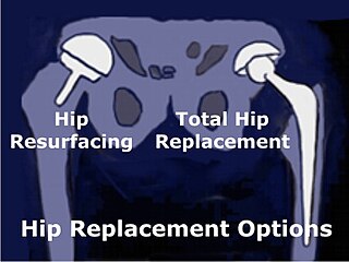 <span class="mw-page-title-main">Hip resurfacing</span>