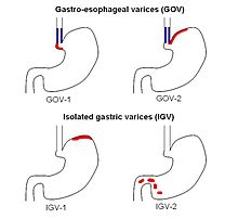 The Sarin classification of gastric varices identifies two types of gastroesophageal varices, where esophageal varices are found concurrently, and two types of isolated gastric varices, found in the absence of esophageal varices. Sarin classification.jpg