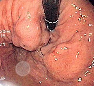 <span class="mw-page-title-main">Gastric varices</span> Medical condition