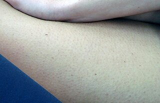 <span class="mw-page-title-main">Lentigo</span> Small pigment spots on skin