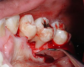 <span class="mw-page-title-main">Furcation defect</span>