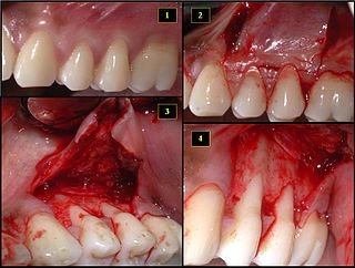 Subepithelial connective tissue graft