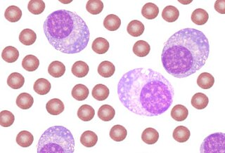 <span class="mw-page-title-main">Plasma cell leukemia</span> Medical condition