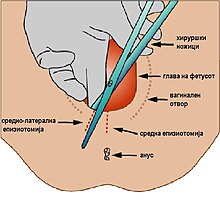 Epiziotomijamk.JPG