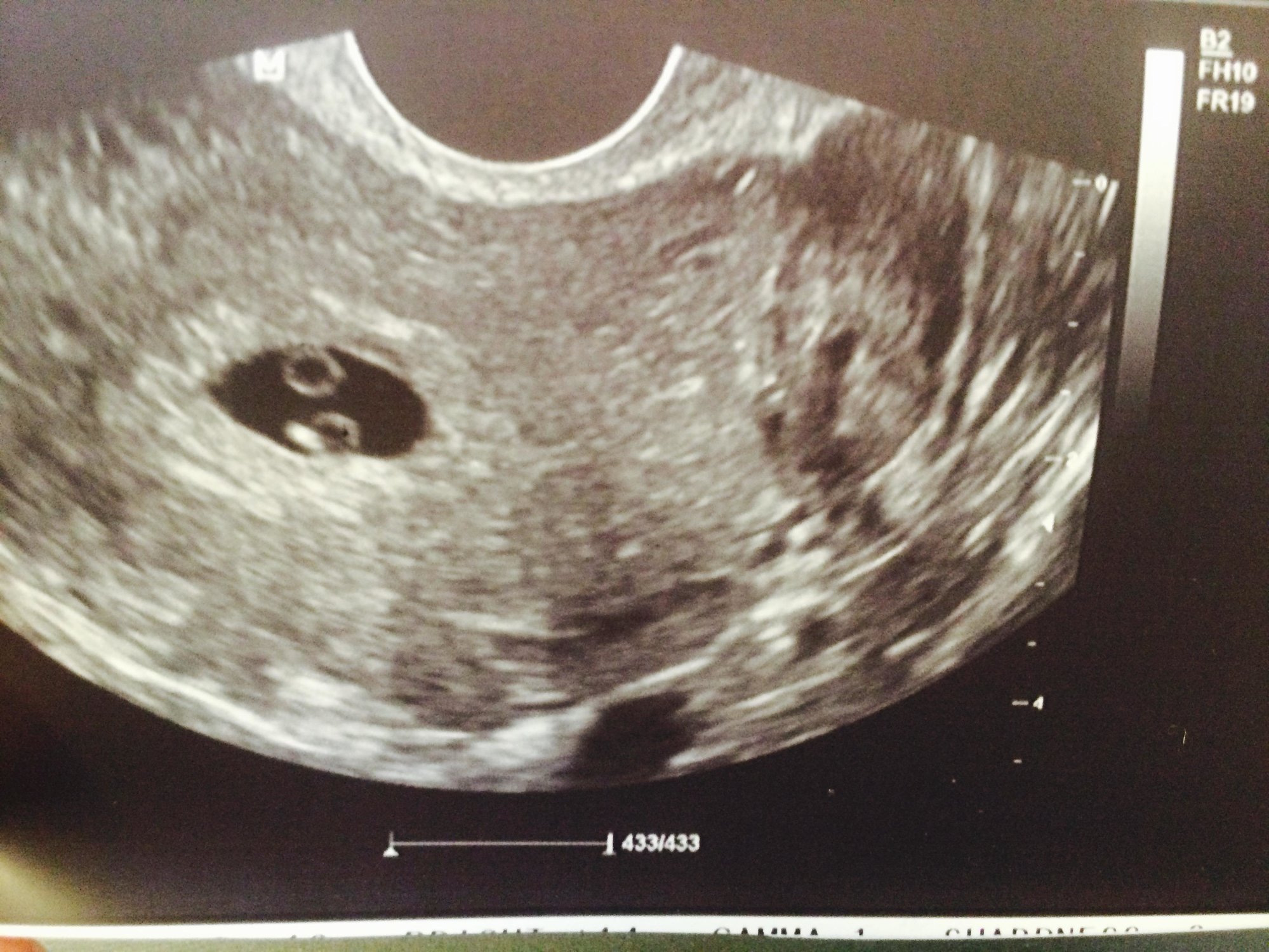 Ultrasound Pictures Of Identical Twins