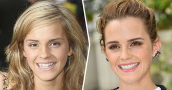 How the Smiles of 15 Celebrities Changed After They Fixed Their Teeth