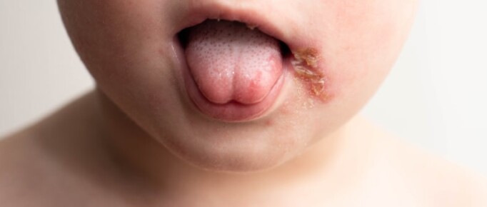 Impetigo