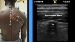 Erector spinae plane block step 5