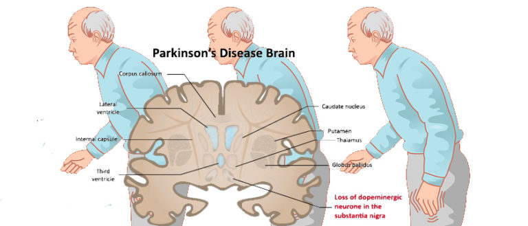 Parkinson's Disease Diagram