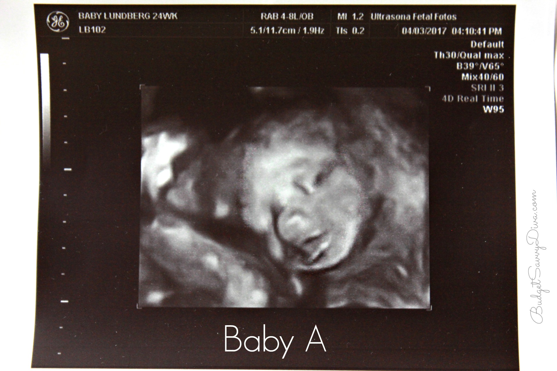 Identical Twins Ultrasound 12 Weeks