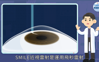 單眼雷射10秒鐘，隔天正常生活，Smile Pro全飛秒近視雷射手術再進化