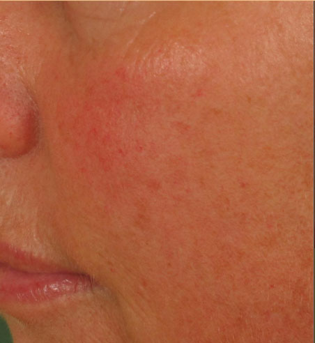 Facial Redness & Broken Capillaries - Clinic One | Dermatology Plastic ...